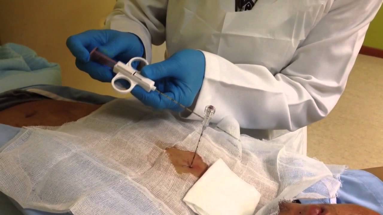 Lung biopsy